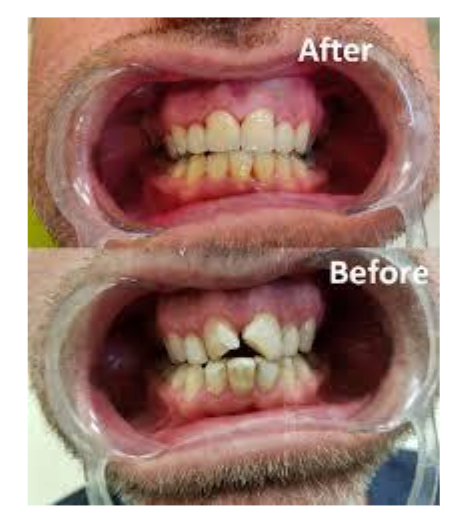 Clear Aligners